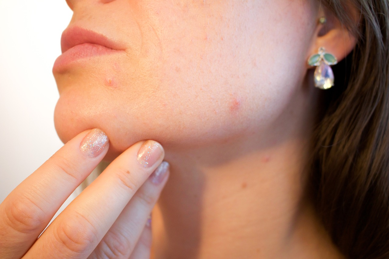 dry skin